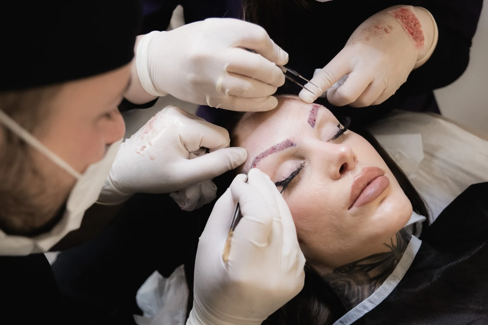 Clinician placing individual eyebrow grafts during an eyebrow transplant procedure