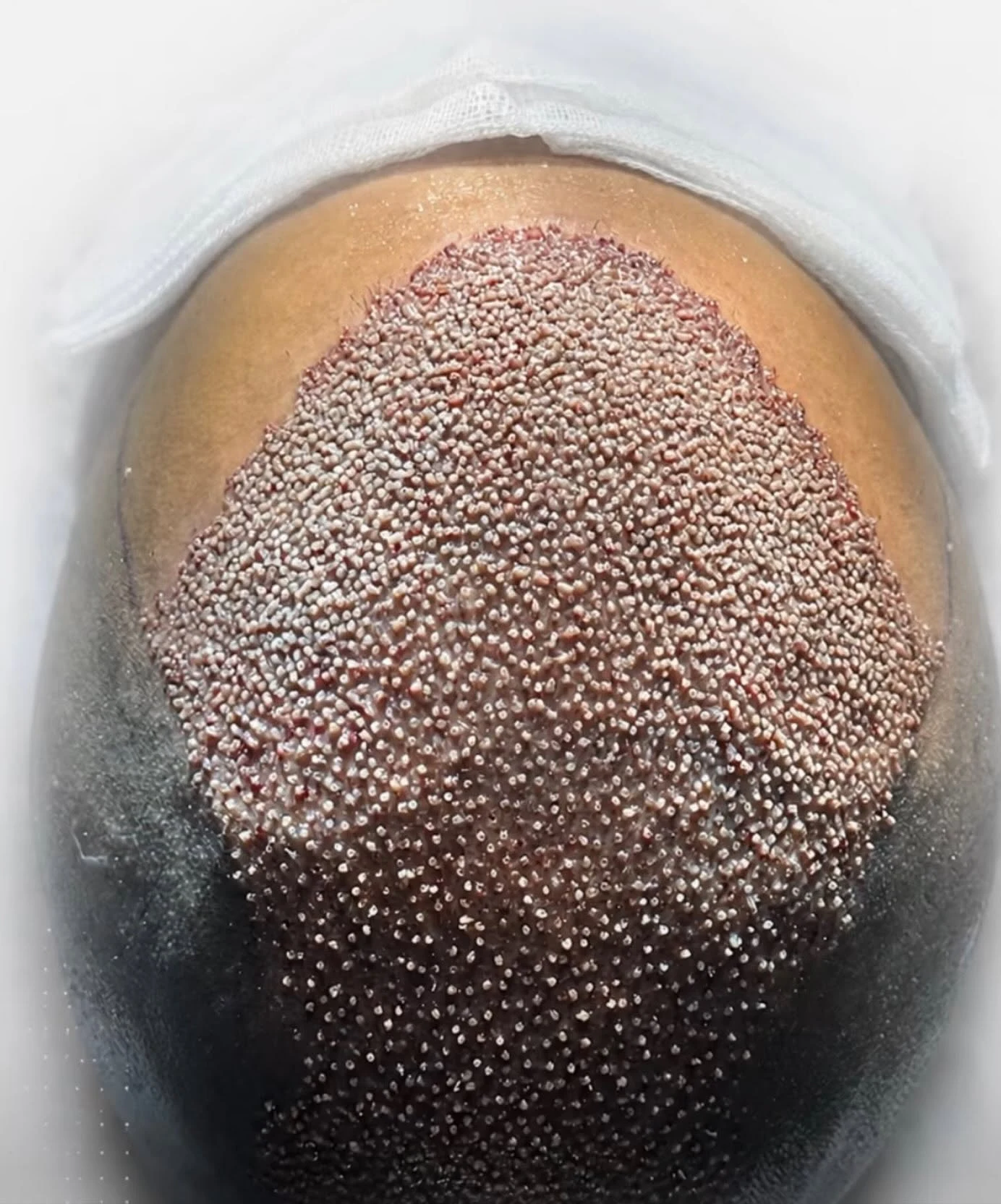 Close detail of graft placement during a hair transplant in Istanbul