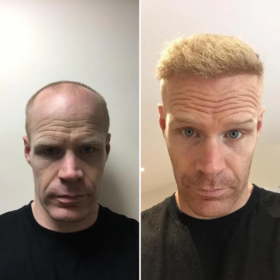 Side-by-side portrait showing a patient before treatment and with fuller hair at follow-up
