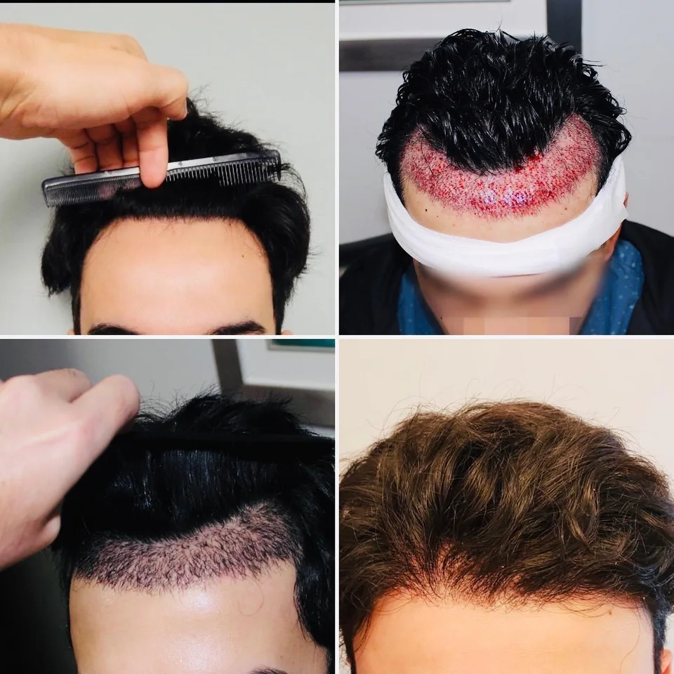 Four-image patient collage showing hairline planning, immediate graft placement and later hair appearance