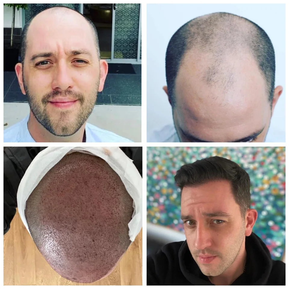 Four-image collage showing a patient’s scalp before treatment, immediately after graft placement and at later follow-up