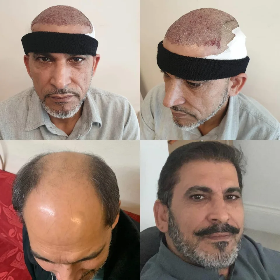 Four-image collage showing a patient on the day of treatment, his thinning crown and hairline beforehand, and fuller hair at follow-up
