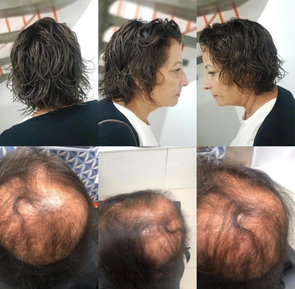 Six-image collage showing a woman’s crown and hair from several angles before treatment and at follow-up