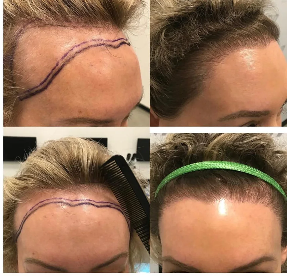 Four-image collage showing a woman’s hairline marked out in surgical pen before treatment and the same hairline at follow-up