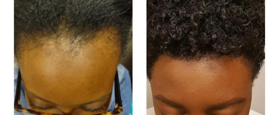 Side-by-side close-up showing a woman’s textured hairline before treatment and at follow-up